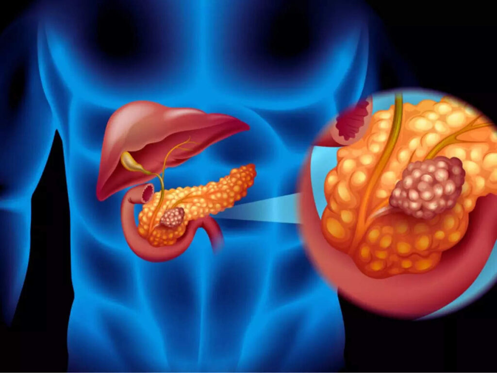 Pancreatic Cancer