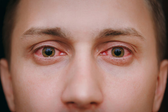 pink-eye-2