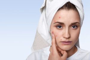 Acne-home-remedies