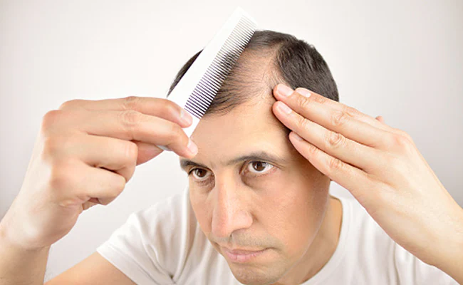 9dknlie_causes-of-hair-fall-in-men_625x300_01_March_23