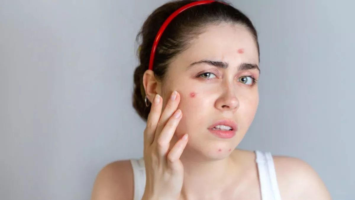 17_12_2022-pimples_23261504