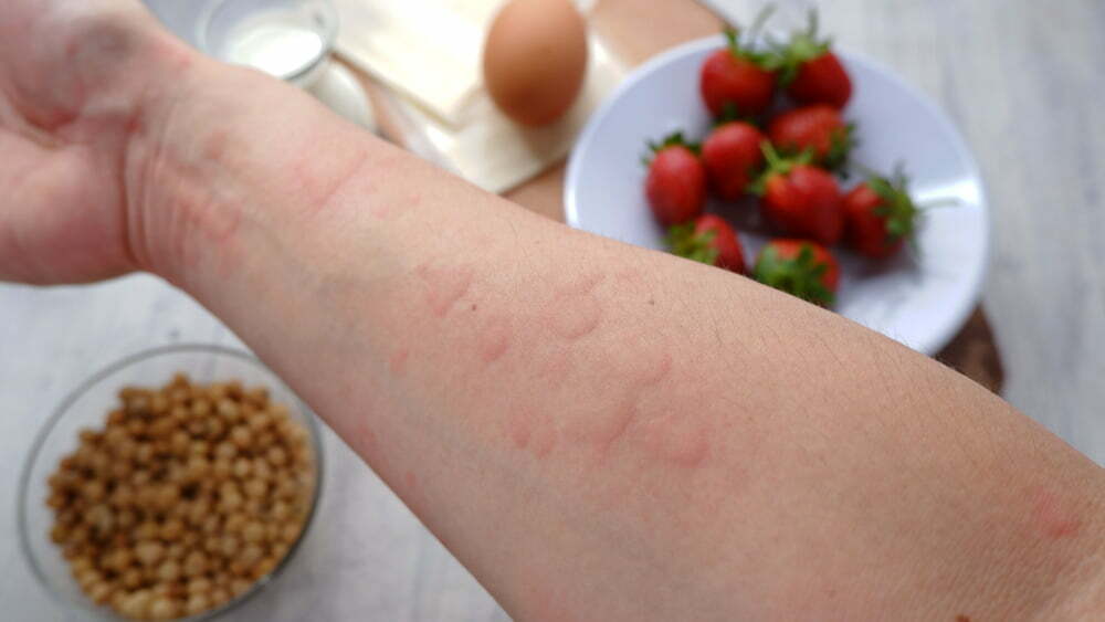 food-allergy-symptoms-for-atlanta-patients